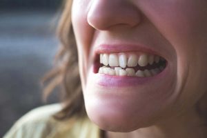 How-to-Straighten-Teeth-Without-Braces