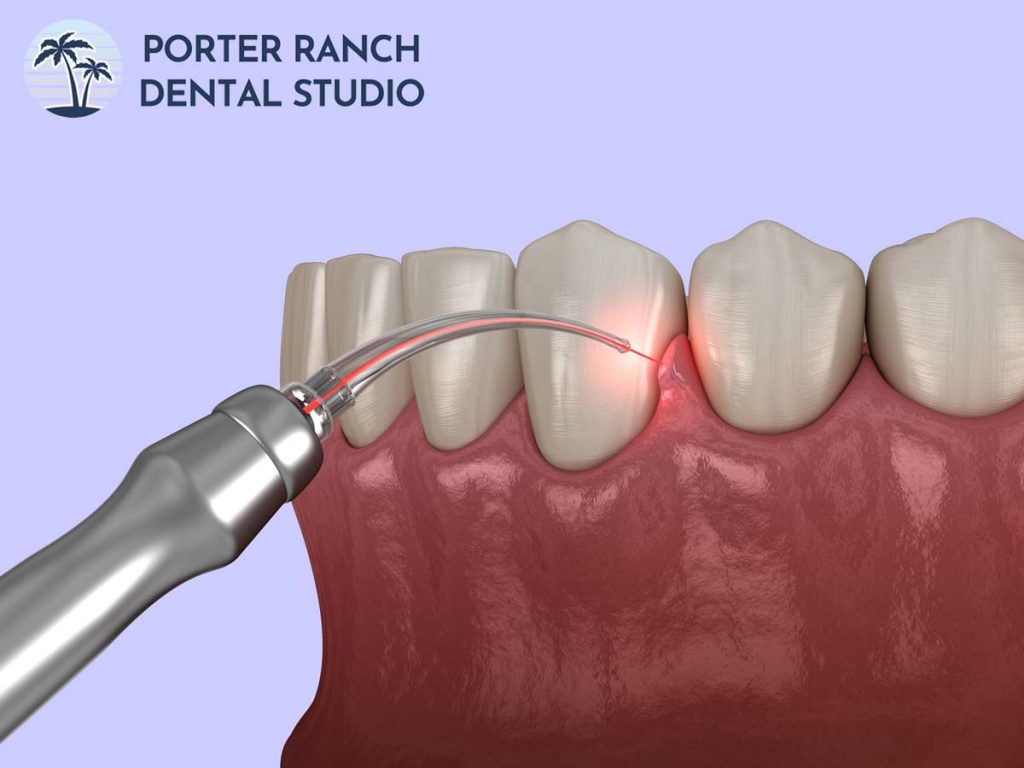 laser-dentistry-gum-contouring
