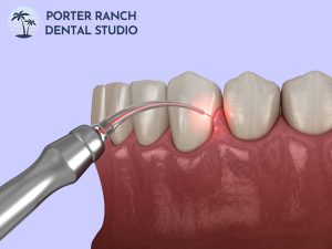 laser-dentistry-gum-contouring