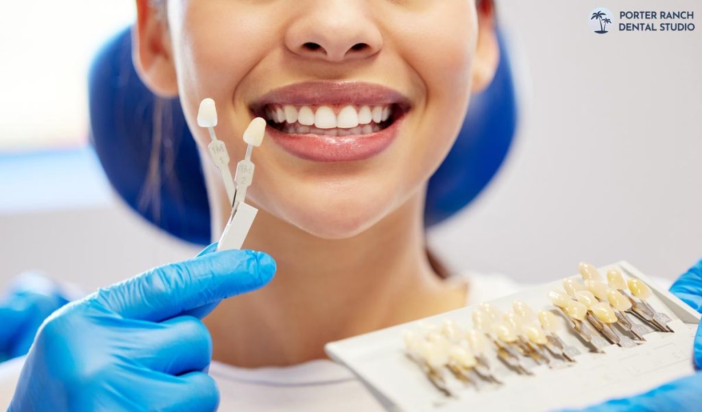 veneers-porter-ranch thumbnail
