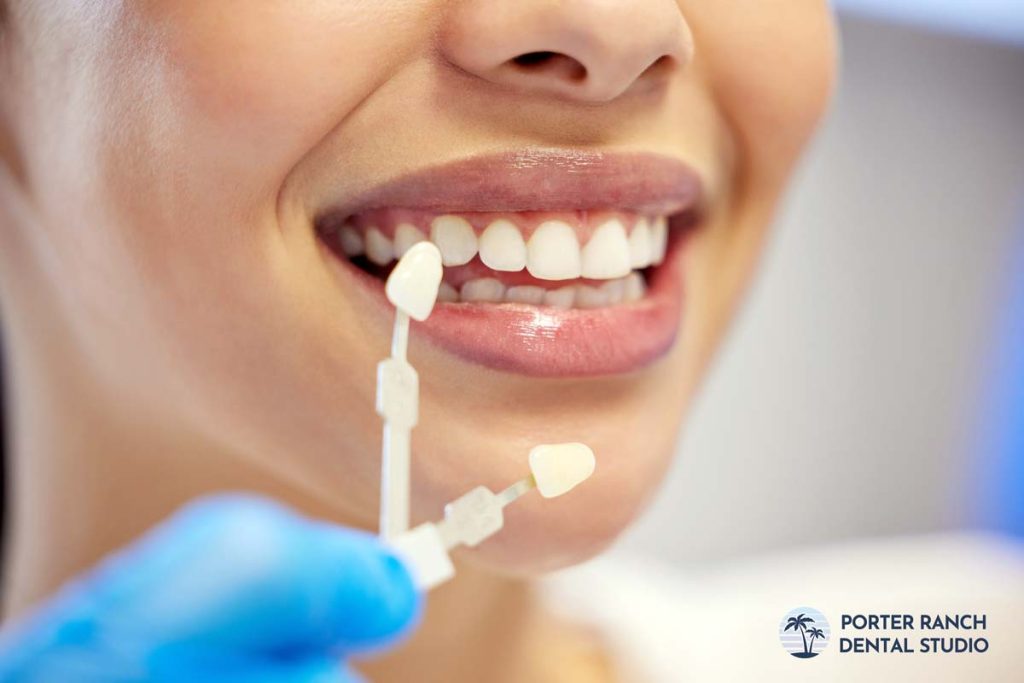 can-veneers-be-removed